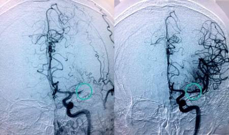 Ictus antes y después