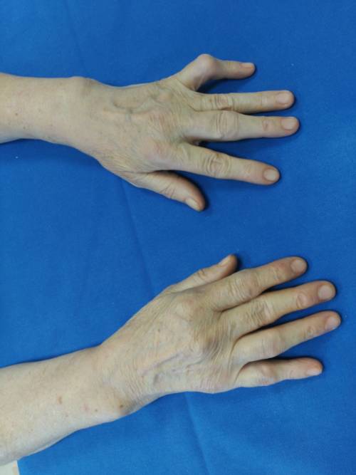 Día Mundial Enfermedades Reumáticas