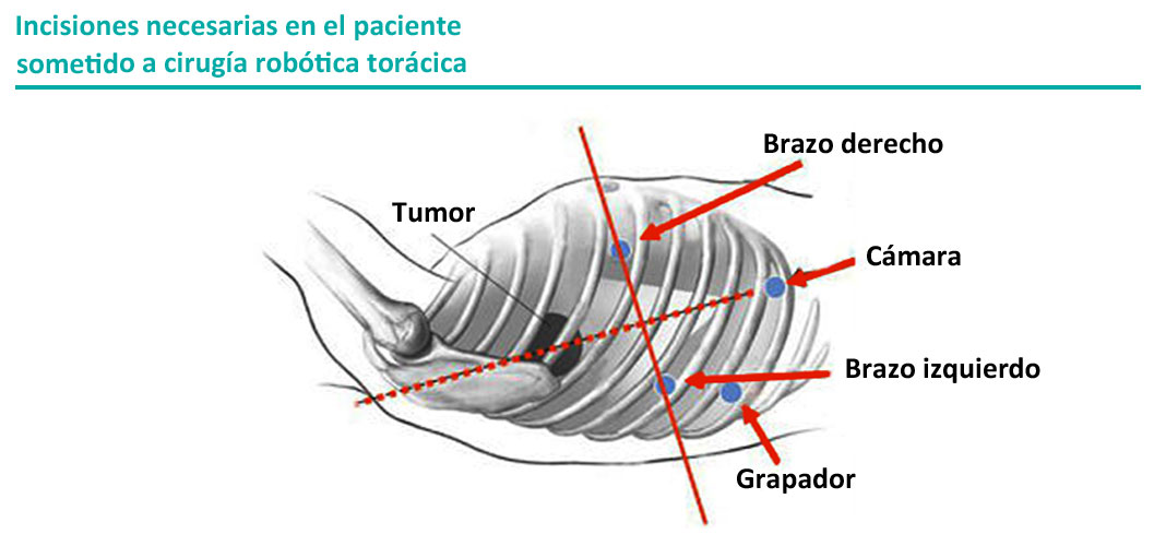 incisiones_cirugia_toracica