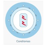 Condiloma