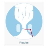 Fístula