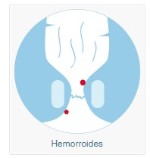 Hemorroides