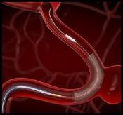 STENT DERIVADOR 7