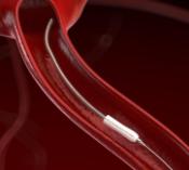 STENT DERIVADOR 9