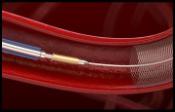 STENT DERIVADOR 11