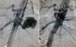 ENDOPROTESIS_RENAL_COLOCADA