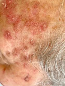 QUERATOSIS ACTÍNICA. 1