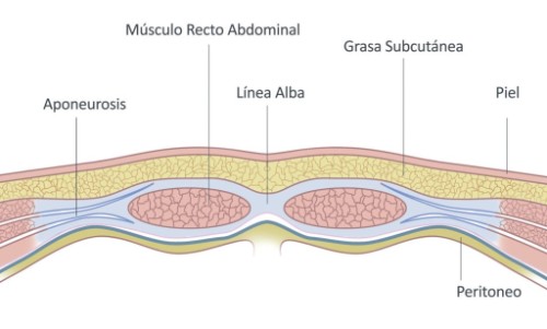 Reparación endoscópica de rectos abdominales