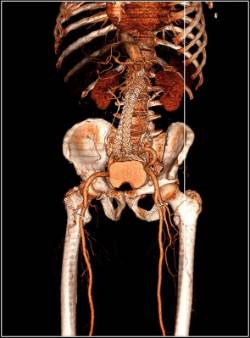 Reparación aneurisma gigante de aorta