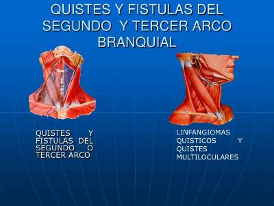 quistes_laterales_cervicales