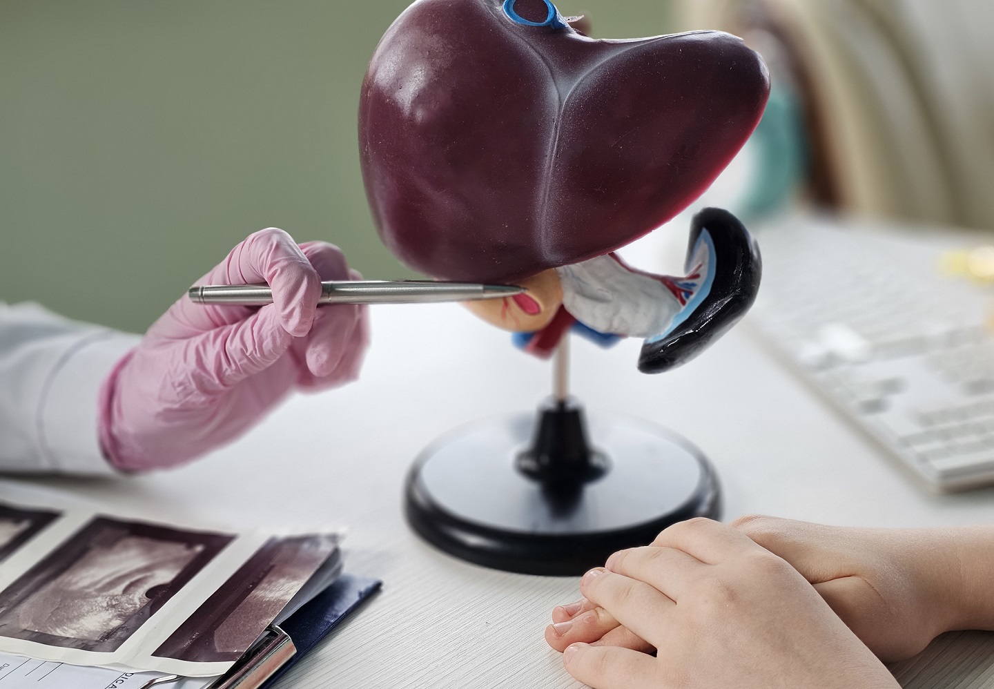 Foto de un especialista mostrando un modelo de hígado para explicar lafibrosis hepatica