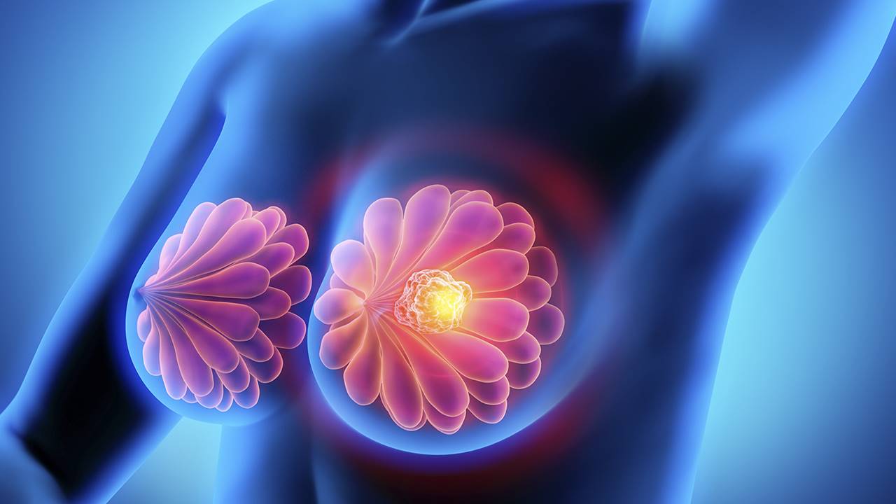 cancer de mama torrevieja quironsalud