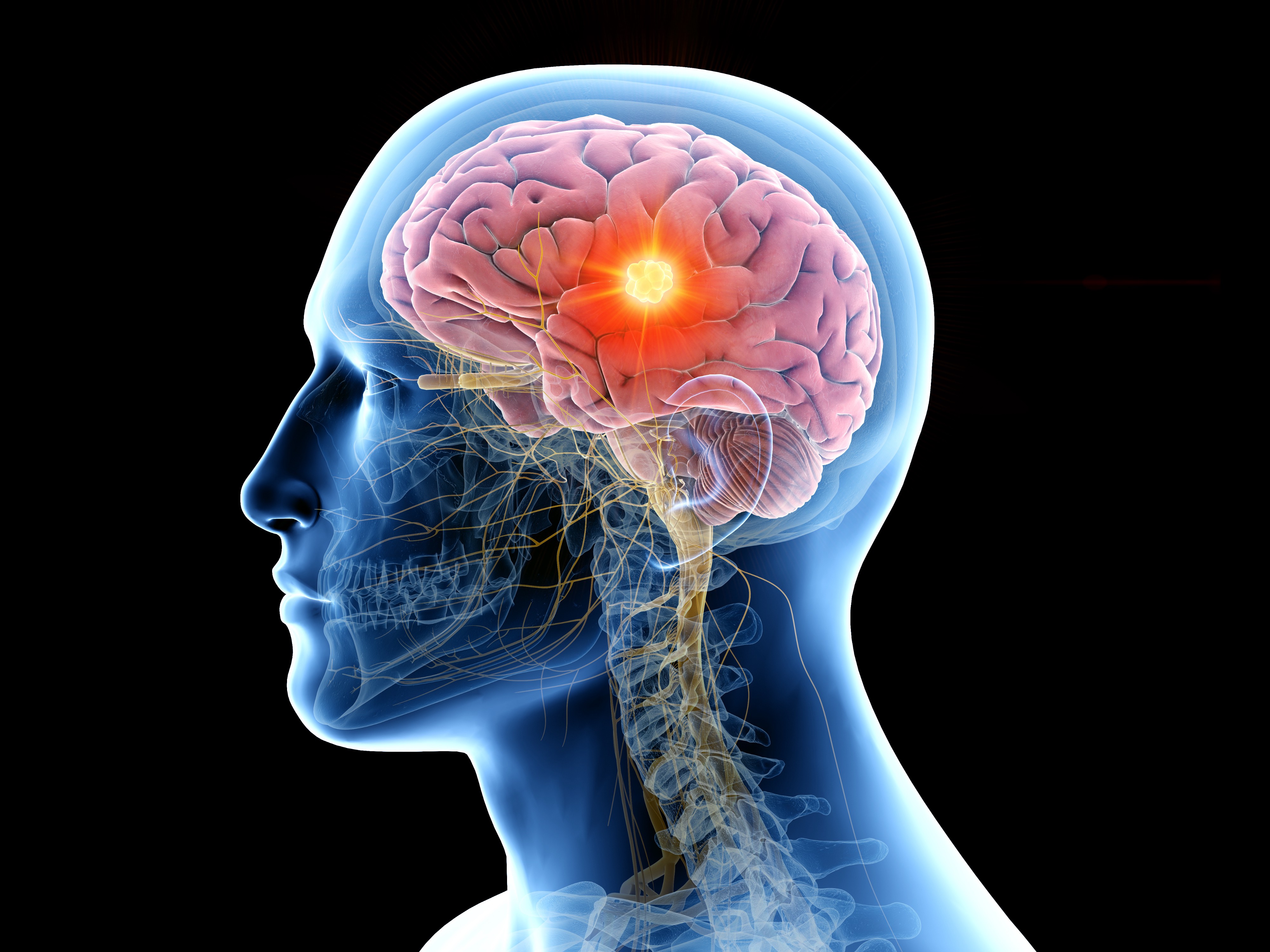 tumor cerebral torrevieja