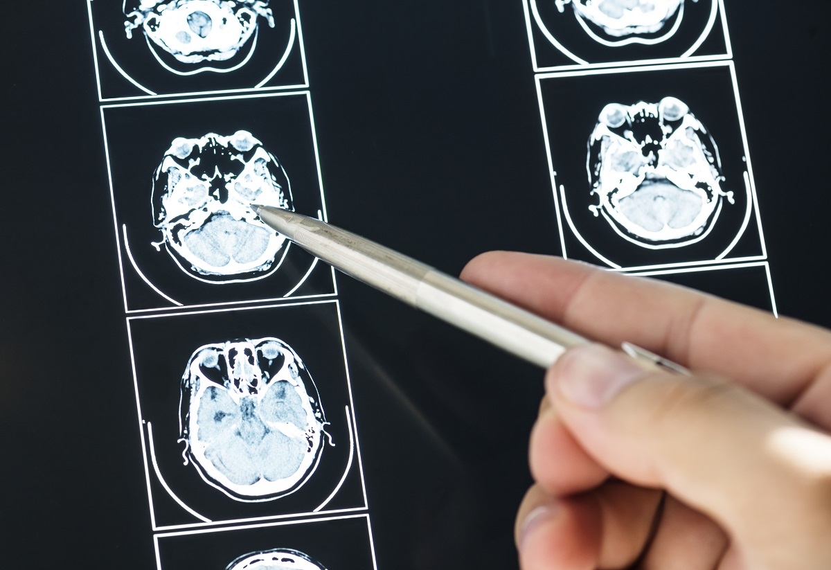 neurorrehabilitacion torrevieja quironsalud