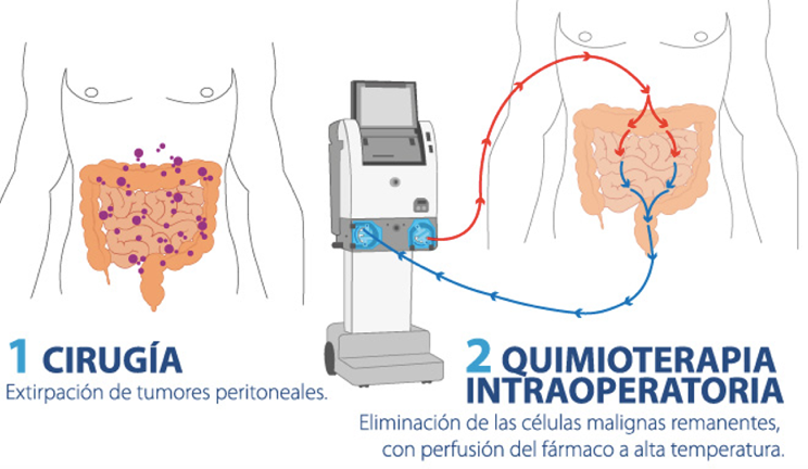 hipec tecnica quironsalud carcinomatosis torrevieja