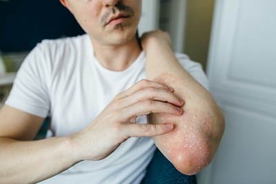 psoriasis tratamiento valencia