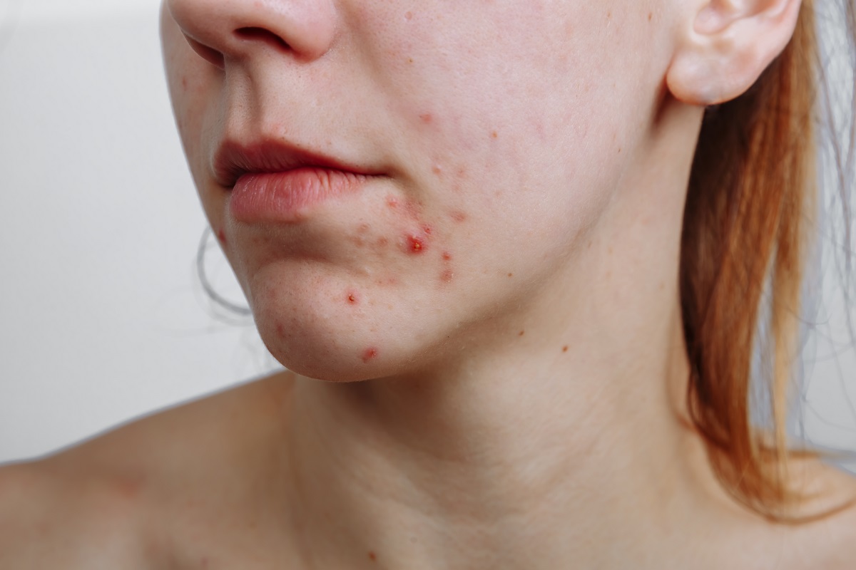 especialistas acne valencia