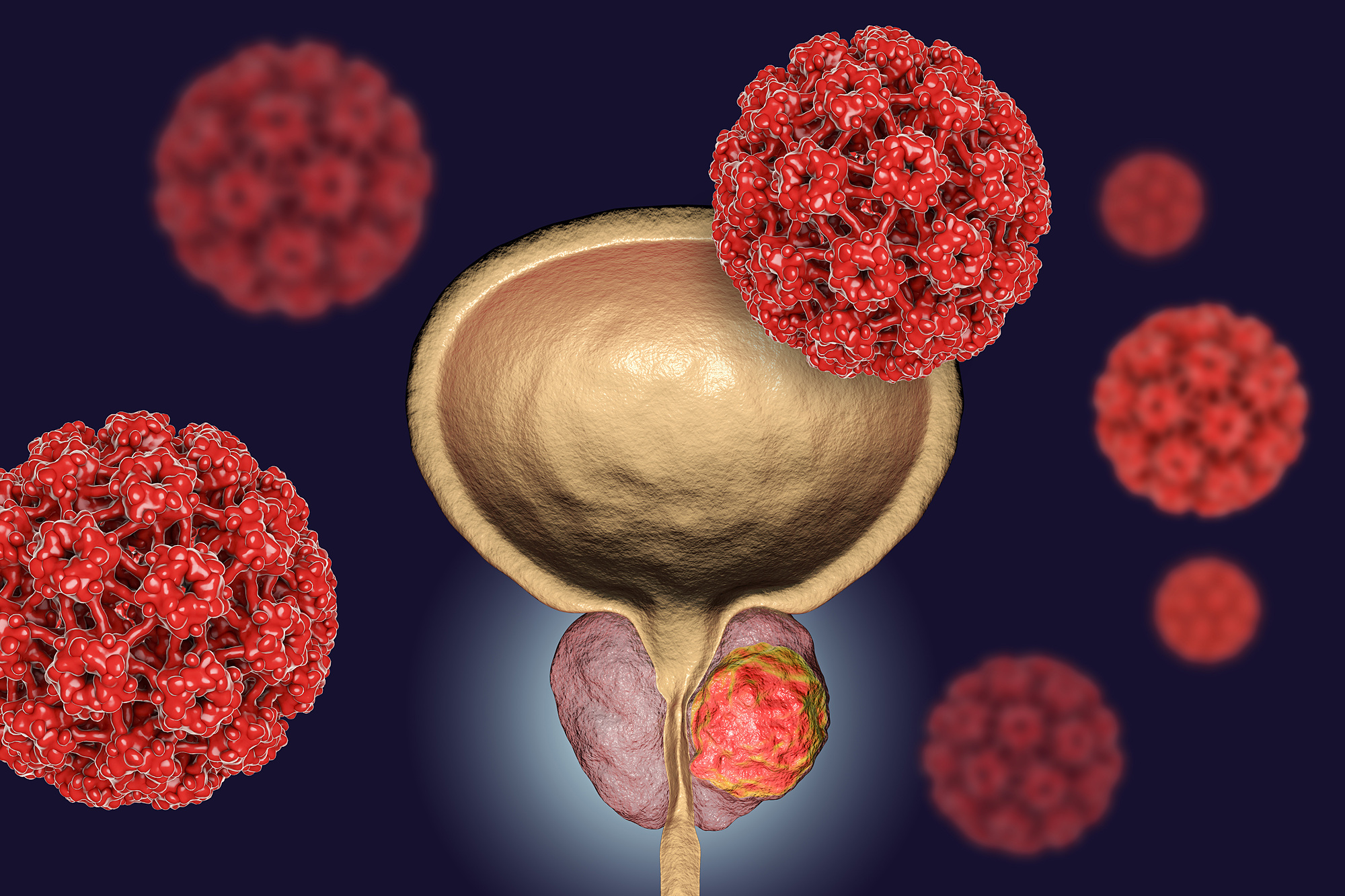 cáncer de prostata chequeo valencia