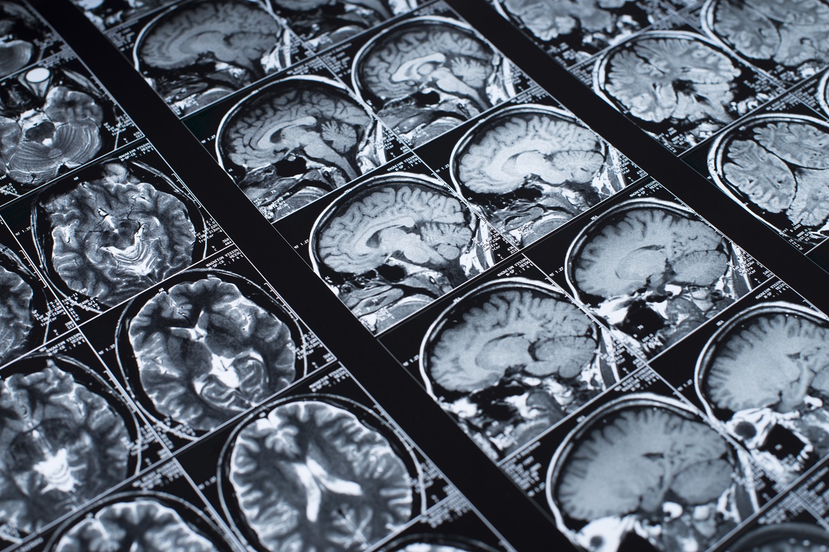 tumor cerebral valencia quironsalud