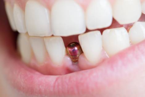 Implantología dental en Valencia Quirónsalud