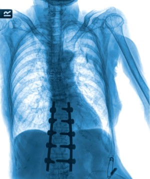 Unidad-cirugia-de-columna-Quironsalud-Valencia