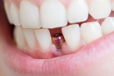 Implantología dental en Valencia Quirónsalud