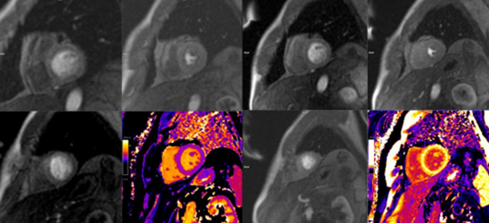 Resonancia magnética de perfusión