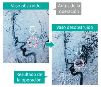 tratamiento-ictus
