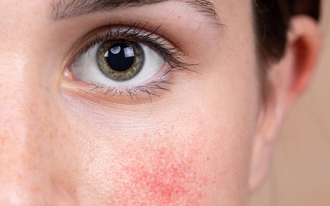tratamiento rosacea vida