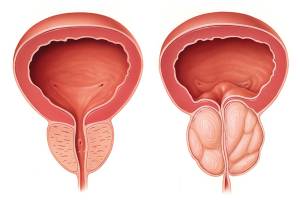 Rezum Vida hiperplasia benigna de prostata quironsalud
