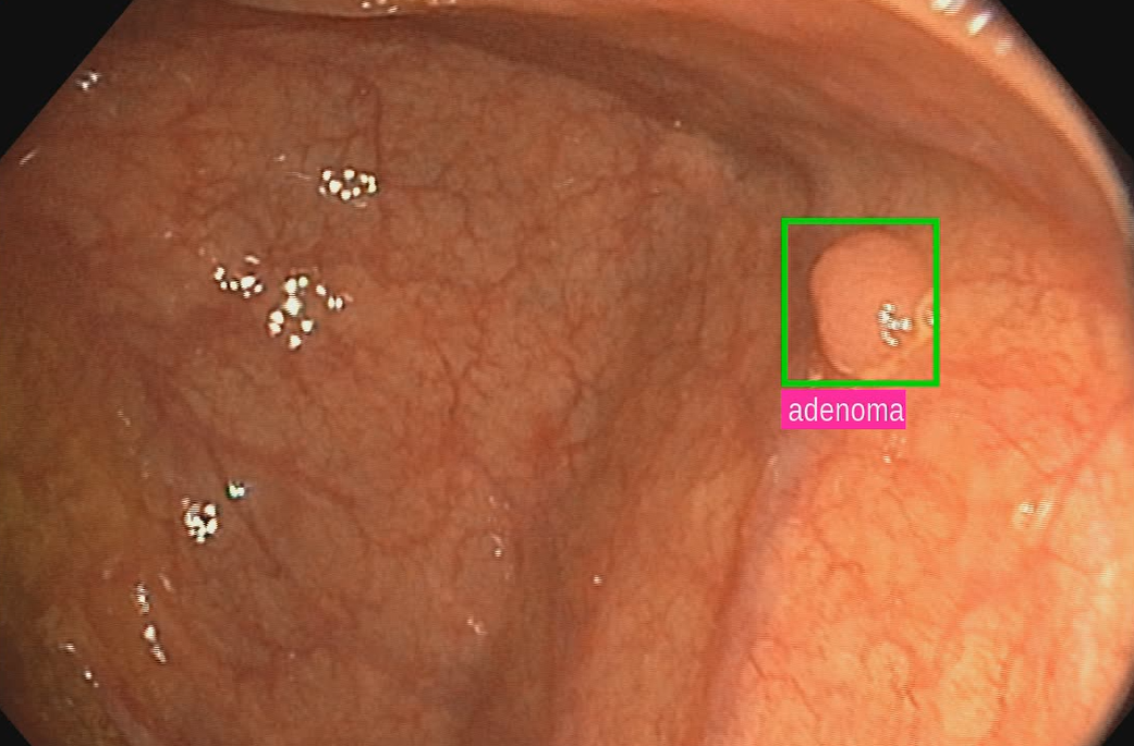 adenoma1