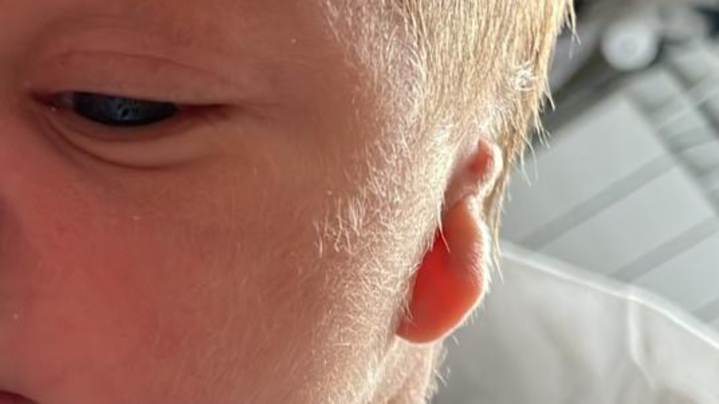 microtia-bebe